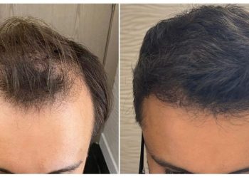 Busca por transplantes capilares dispara em clínicas especializadas - Foto: Reprodução