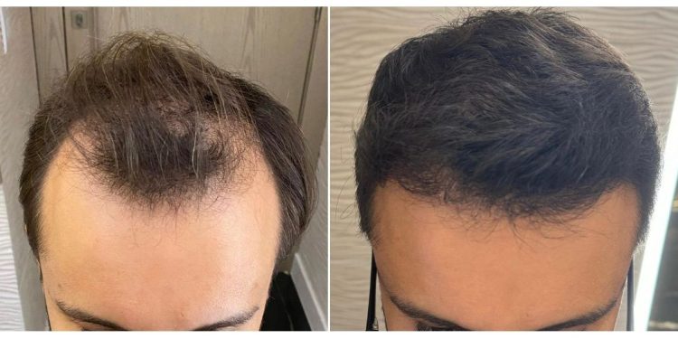 Busca por transplantes capilares dispara em clínicas especializadas - Foto: Reprodução