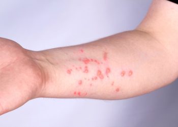 Saúde corrige dados e diz que ES registrou 8 casos de Mpox em 2024 - Foto: Getty Images