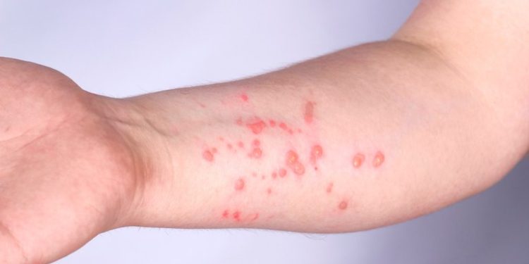 Saúde corrige dados e diz que ES registrou 8 casos de Mpox em 2024 - Foto: Getty Images