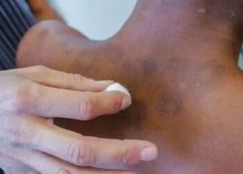 Janeiro Roxo: Combate à Hanseniase no Brasil - Foto: SMS de Mesquita/RJ