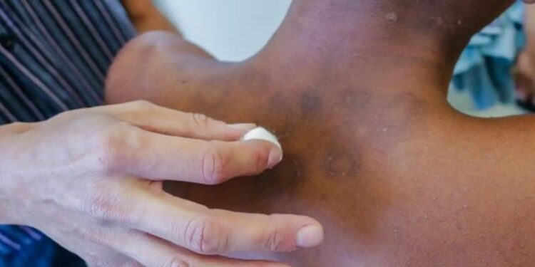 Janeiro Roxo: Combate à Hanseniase no Brasil - Foto: SMS de Mesquita/RJ