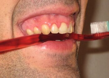 Falta de higiene bucal aumenta o risco de câncer de boca - Foto: Reprodução