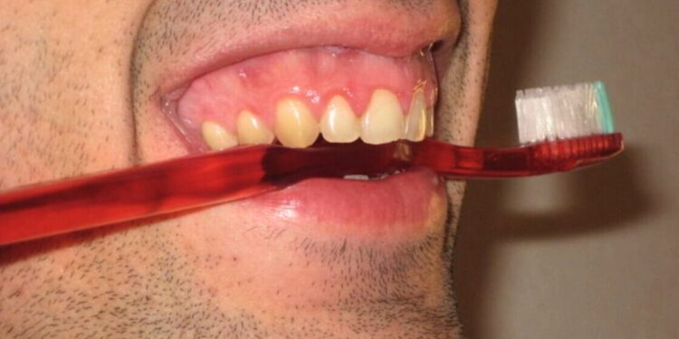 Falta de higiene bucal aumenta o risco de câncer de boca - Foto: Reprodução