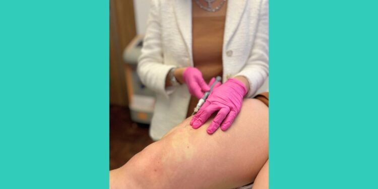 Dor nas pernas, inchaço e hematomas? Pode ser lipedema - Foto: Reprodução