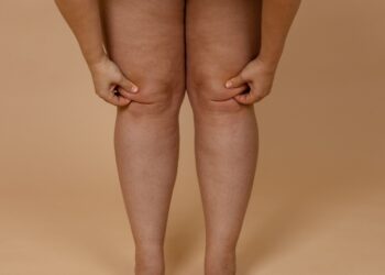 Menopausa pode desencadear lipedema - Foto: Reprodução