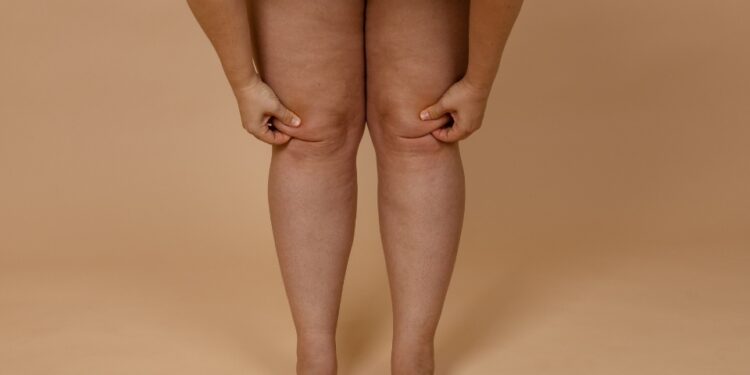 Menopausa pode desencadear lipedema - Foto: Reprodução