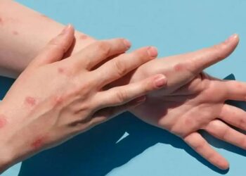 Primeiro caso de ‘Varíola dos Macacos’ registrado em Linhares: Especialista alerta para os cuidados com a doença - Foto: Reprodução