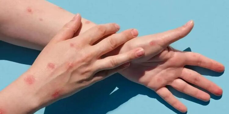 Primeiro caso de ‘Varíola dos Macacos’ registrado em Linhares: Especialista alerta para os cuidados com a doença - Foto: Reprodução