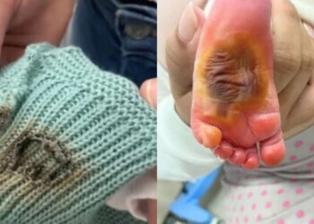 Queimadura de bebê em hospital estadual do ES é investigada pelo MPES - Foto: Reprodução