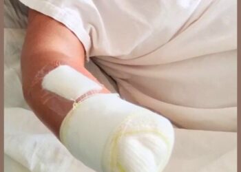 Mulher tem mão amputada após agressão do marido com facão em São Domingos do Norte - Foto: PCES