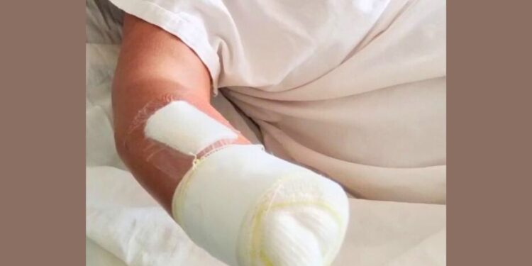 Mulher tem mão amputada após agressão do marido com facão em São Domingos do Norte - Foto: PCES
