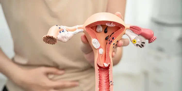 Março Amarelo: Endometriose Afeta Mais de 7 Milhões de Brasileiras, Alerta Especialista da Unimed Cuiabá